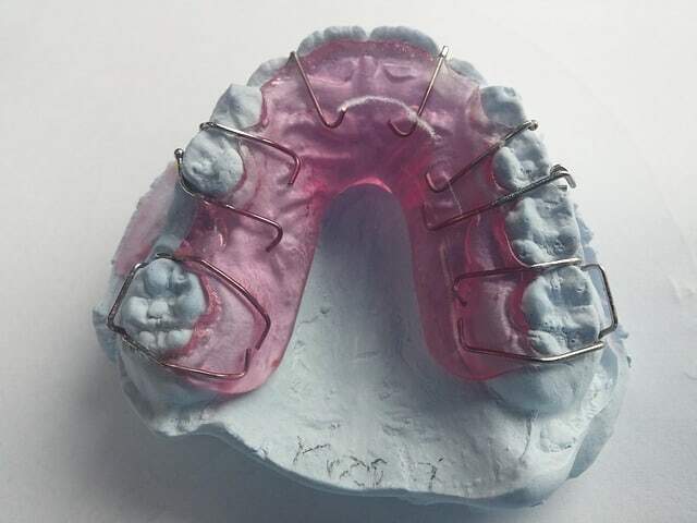dental modeling wax in a gypsum model